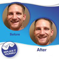 Dental Veneer Set Includes Upper And Lower Teeth For Natural Smile