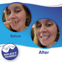 Dental Veneer Set Includes Upper And Lower Teeth For Natural Smile