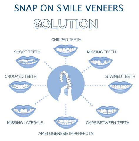 Dental Veneer Set Includes Upper And Lower Teeth For Natural Smile