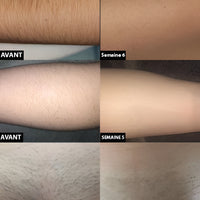 Laser Hair Removal For Long-Lasting Reduction And Smooth Skin