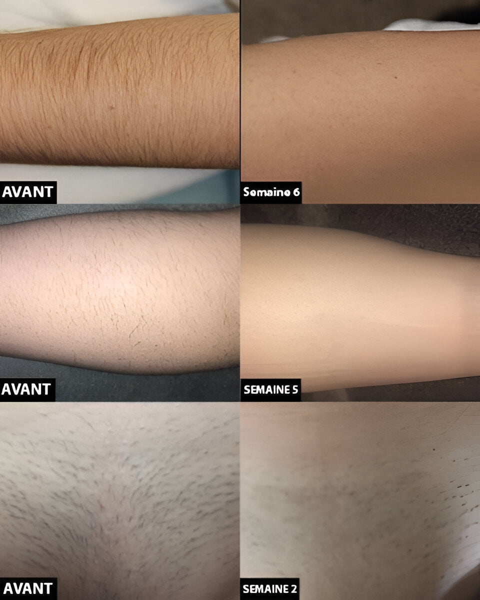Laser Hair Removal For Long-Lasting Reduction And Smooth Skin